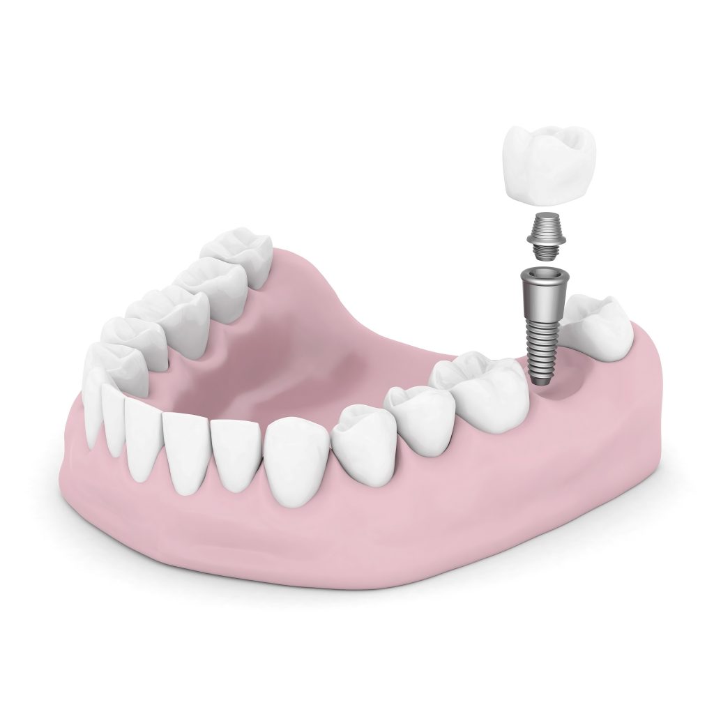 Dental Implants Stone Post Family Dental Overland Park, KS