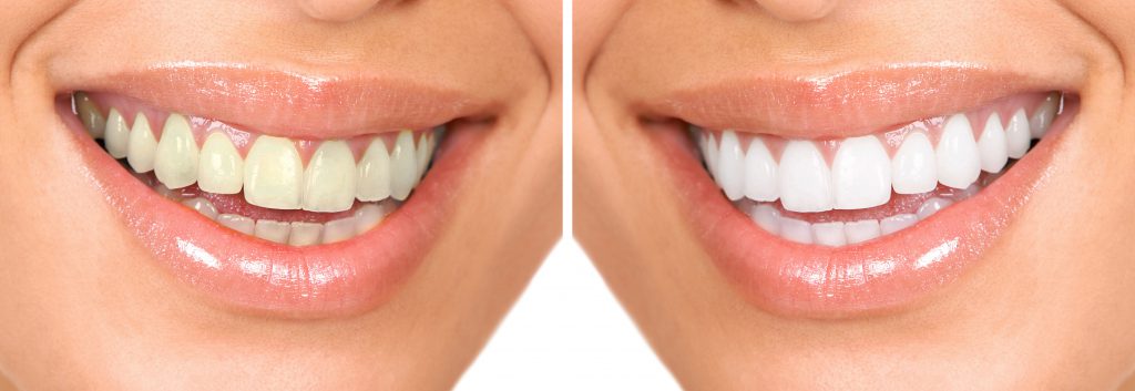 Teeth Whitening Overland Park, KS